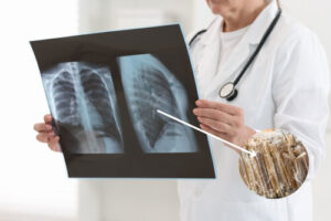 asbestosis enfermedades